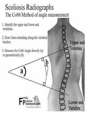 https://www.my-personaltrainer.it/scoliosis.jpg